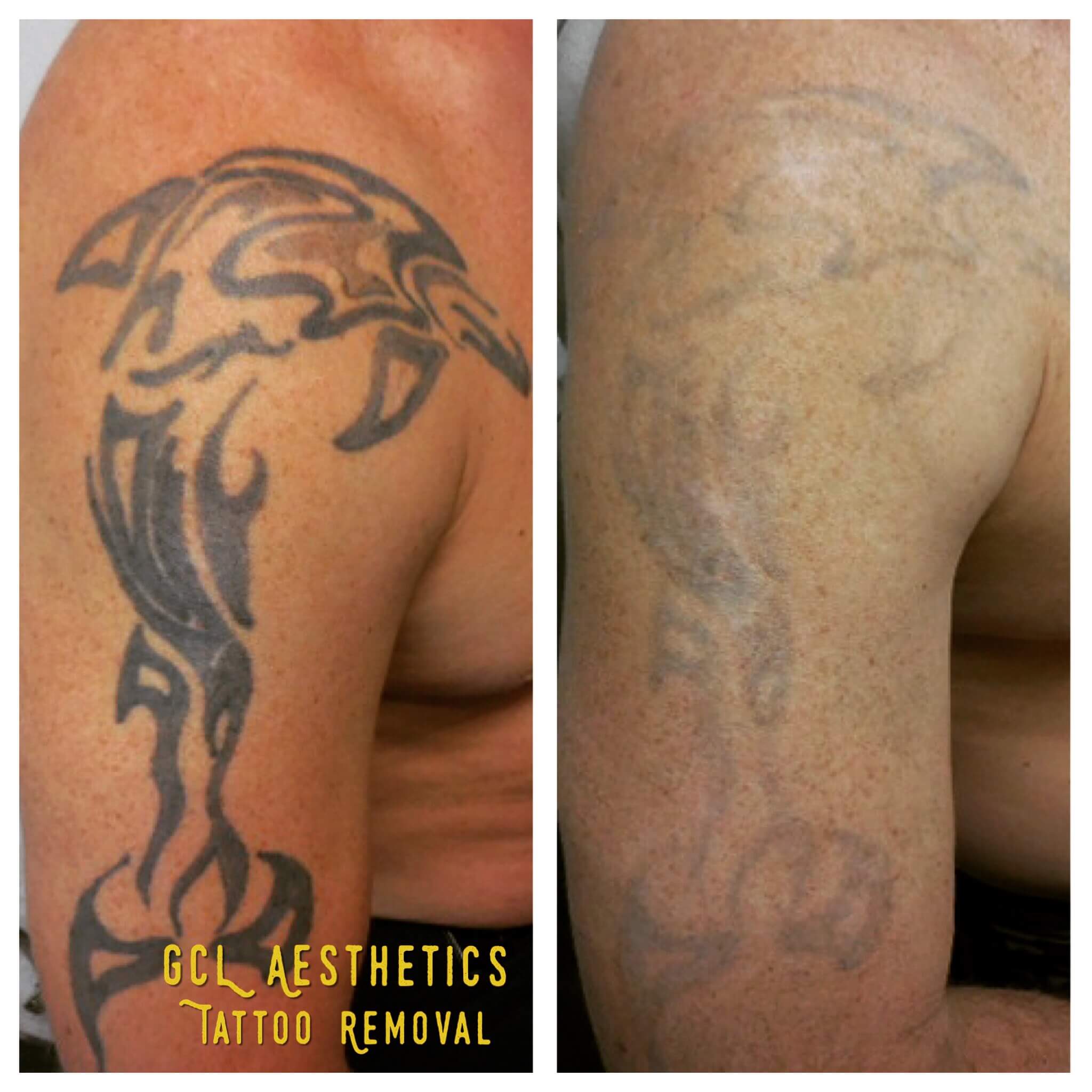 Laser Tattoo Removal  Paragould Plastic Surgery  Paragould AR